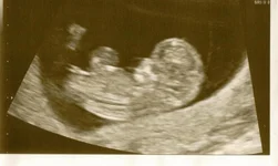 03052012 ultrasound 3.webp